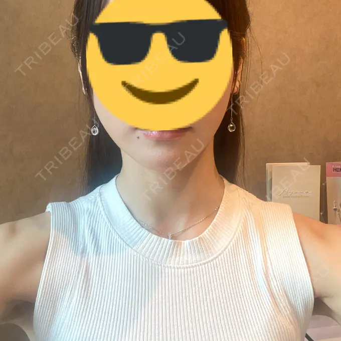 ボトックス（エラ・小顔） / ボトックス（肩） / ボトックス（首） AYANAフィラーズクリニック 渋谷院 BEFORE メイン用