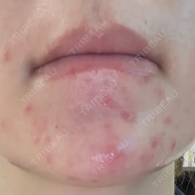 ピーリング（ニキビ・毛穴） / 光治療（フォトフェイシャルなど） MKクリニック 日本橋院 BEFORE メイン用