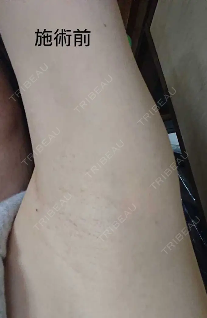 ワキ汗治療（ボトックス） 大阪TAクリニック BEFORE メイン用