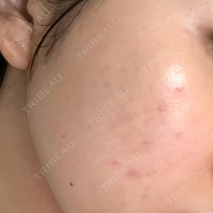 ピーリング（ニキビ・毛穴） 豊洲内科・糖尿病 / 形成・美容外科クリニック BEFORE メイン用