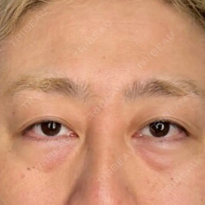 ほくろ・いぼ切除（肌） / クマ治療 / シミ取りレーザー 表参道ウィズ・クリニック BEFORE メイン用