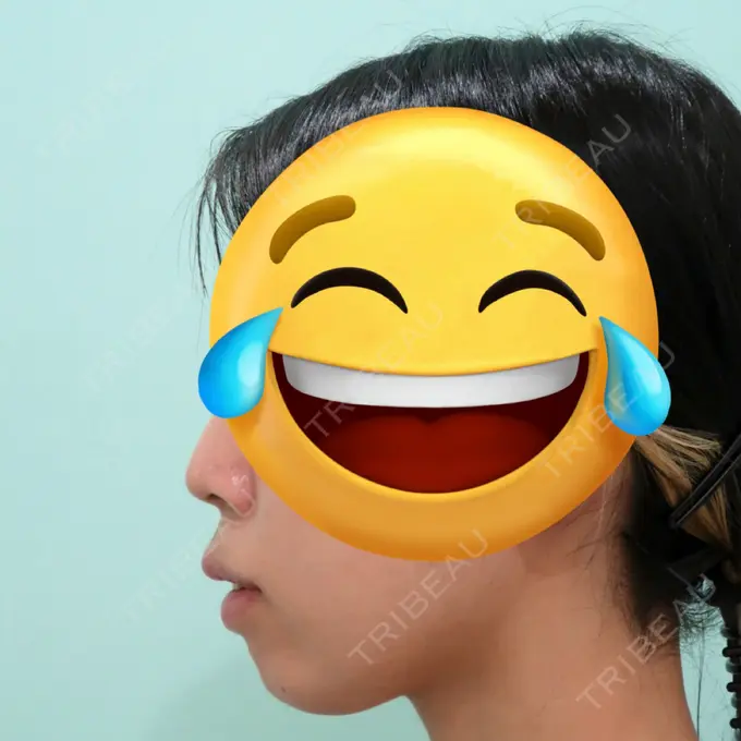 あごプロテーゼ / その他（輪郭） WOM CLINIC GINZA （ワム クリニック ギンザ） BEFORE メイン用