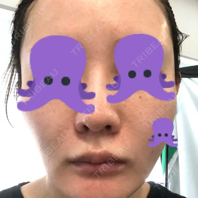 ベビーコラーゲン / ダーマペン ルラ美容クリニック 渋谷本院 BEFORE メイン用