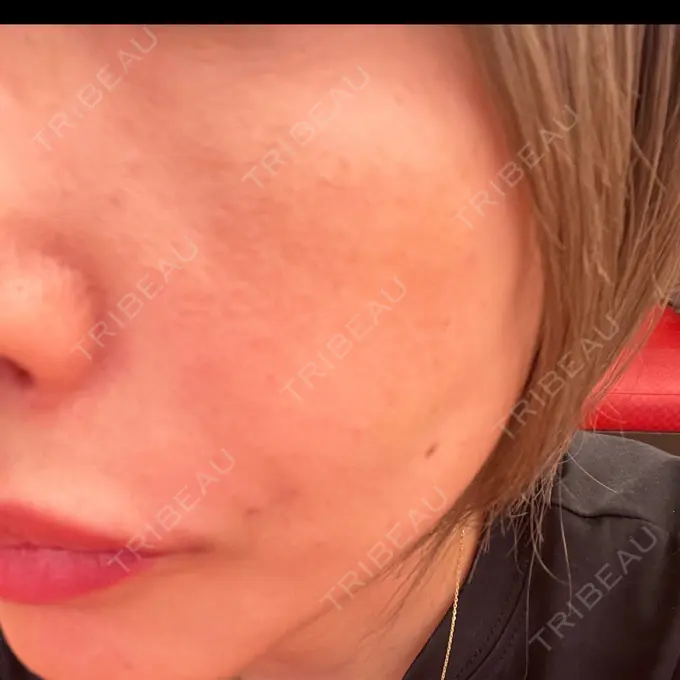 ピコレーザートーニング（美白・肝斑） エースクリニック 大阪梅田HEPナビオ院 BEFORE メイン用