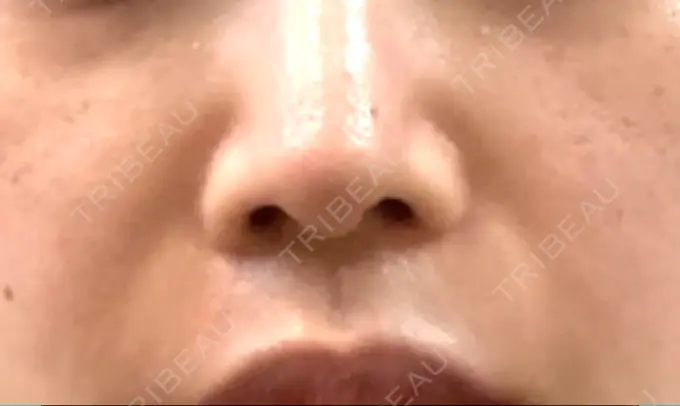 肌ヒアルロン酸注入（たるみ・シワ改善） / ヒアルロン酸注入（鼻翼基部） ブルームクリニック（BLOOM CLINIC） BEFORE メイン用