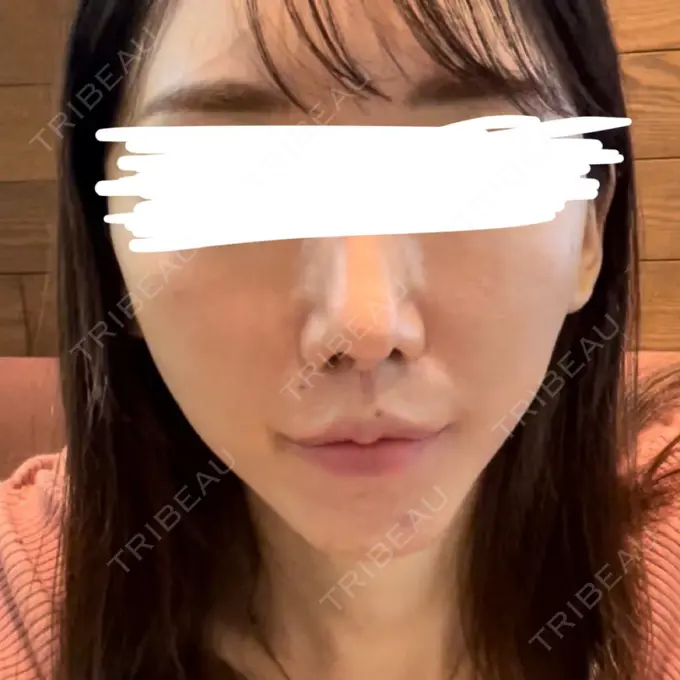 ピーリング（ニキビ・毛穴） ルラ美容クリニック 神戸院 BEFORE メイン用