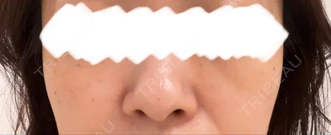 光治療（フォトフェイシャルなど） MKクリニック 日本橋院 BEFORE メイン用