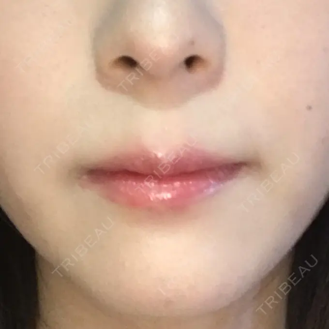 ヒアルロン酸注入（唇） LIKI CLINIC KOBE BEFORE メイン用