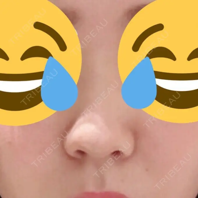 鼻尖形成（切開） / 鼻中隔延長（切開） / 軟骨移植 / 骨切幅寄せ / ワシ鼻修正・ハンプ切除 / 鼻尖縮小 / その他（鼻） ラミチェ美容整形外科 BEFORE メイン用