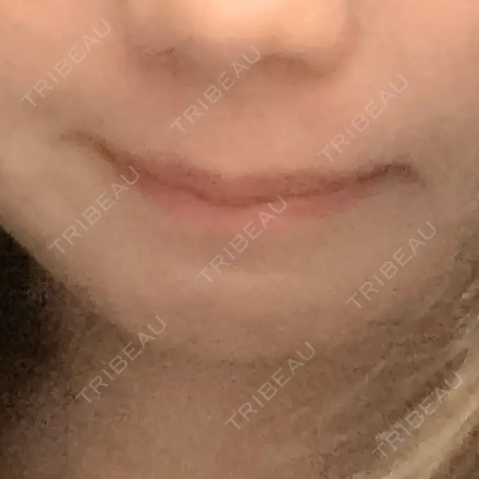 ボトックス（あご） しらゆりメディカルクリニック （旧しらゆりビューティークリニック） BEFORE メイン用