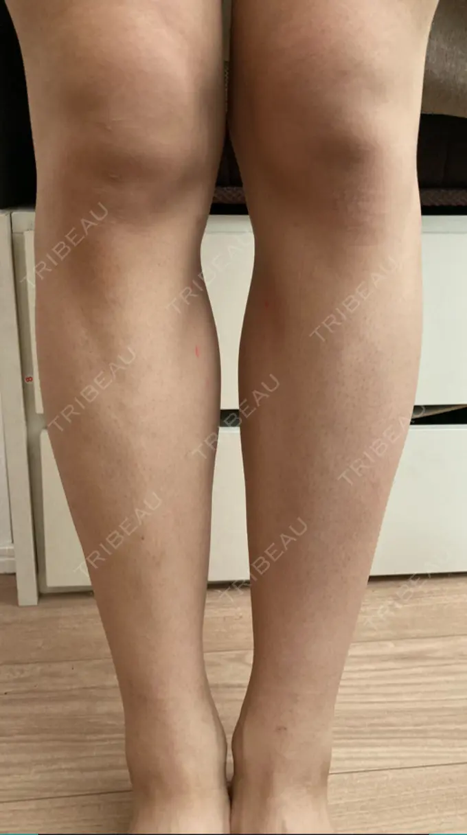 脂肪吸引（脚） L‘amour clinic Tokyo【ラムールクリニック東京】 BEFORE メイン用