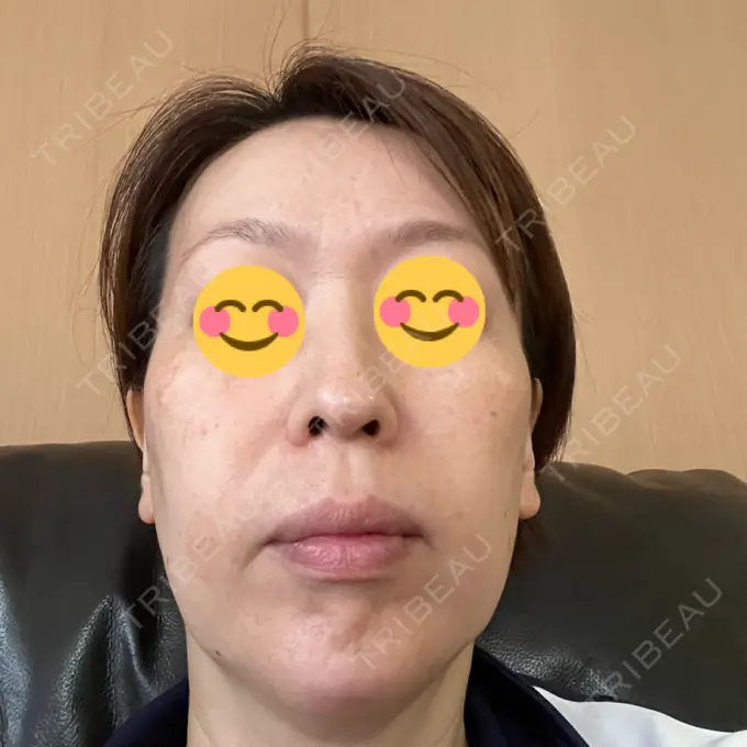 イオン導入 / ルメッカ ルラ美容クリニック 大宮院 / ルラスキンクリニック 大宮院 BEFORE メイン用