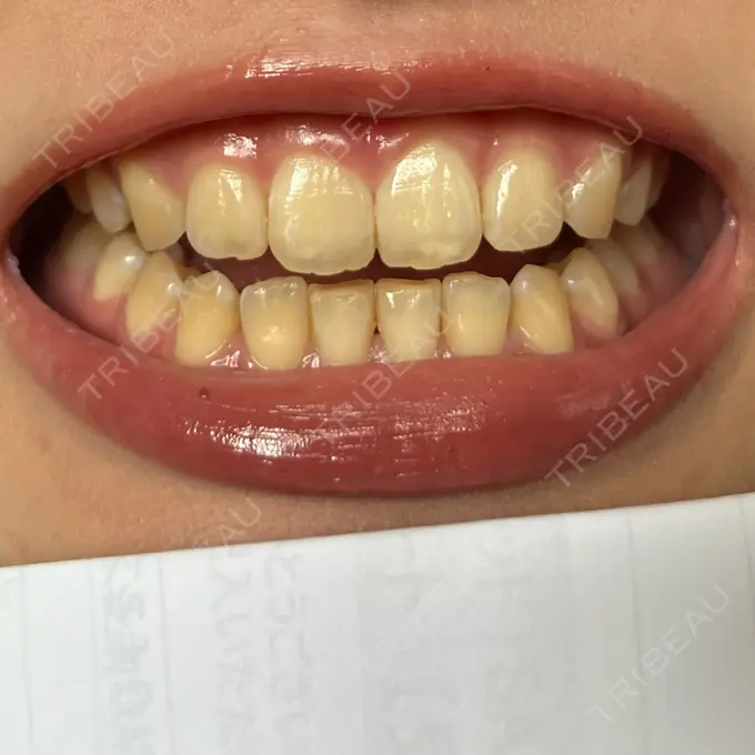 ホワイトニング SK新宿歌舞伎町美容外科・歯科 BEFORE メイン用