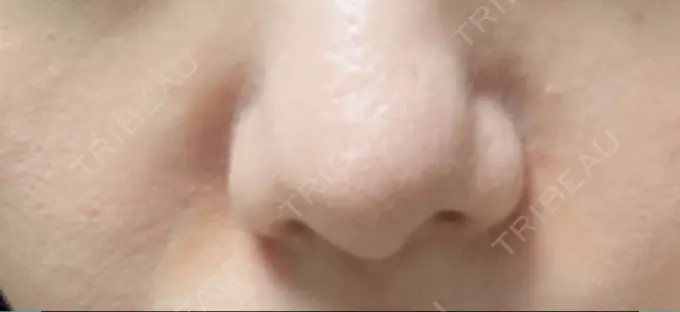 マイクロボトックス / ヒアルロン酸注入（鼻翼基部） 銀座みゆき通り美容外科 大阪梅田院 BEFORE メイン用