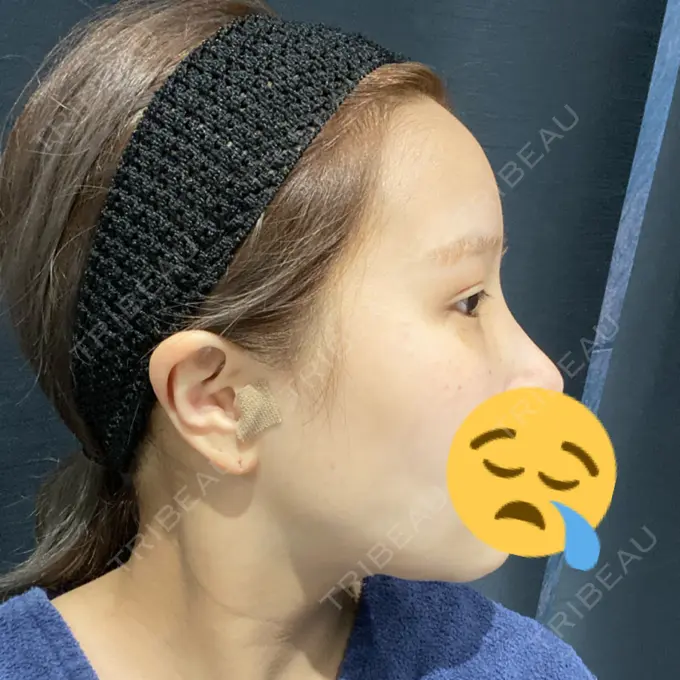 脂肪吸引（顔） Casa de GRACIA GINZA 【カーサデグラシアギンザ】 BEFORE メイン用