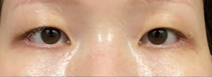 二重埋没 / ボトックス（エラ・小顔） 日本ウェルネス再生クリニック BEFORE メイン用