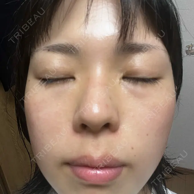 エレクトロポレーション / ピーリング（ハリ・ツヤ） ライズワン美容皮膚科クリニック BEFORE メイン用