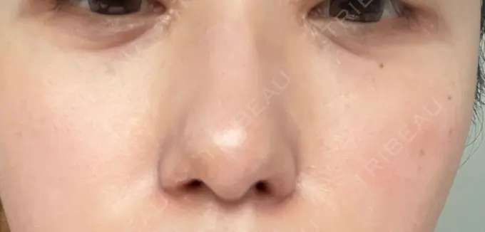 光治療（フォトフェイシャルなど） くさのたろうクリニック BEFORE メイン用