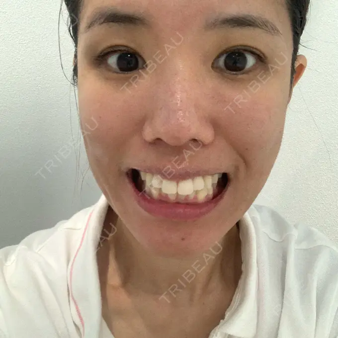 ホワイトニング 三鷹ヒロクリニック 北口院 （医療脱毛） BEFORE メイン用