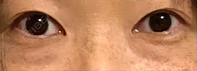 スネコス TCB東京中央美容外科 仙台駅前院 BEFORE メイン用