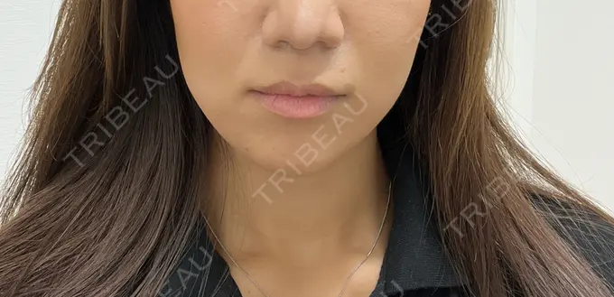 脂肪溶解注射（顔） ルラ美容クリニック 神戸院 BEFORE メイン用