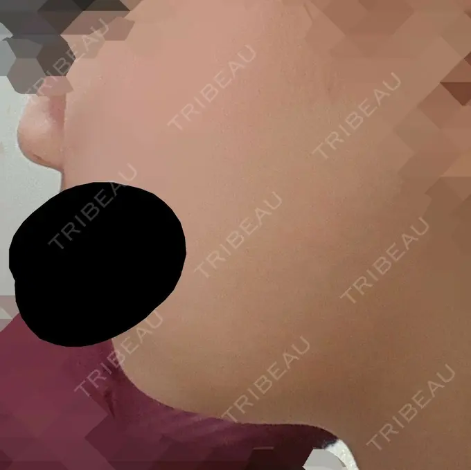 脂肪溶解注射（顔） ハートライフクリニック BEFORE メイン用