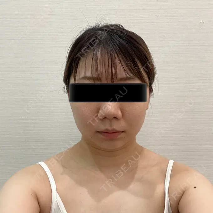 脂肪吸引（顔） / メーラーファット除去 / ボトックス（あご） / ヒアルロン酸注入（あご） / ボトックス（エラ・小顔） WOM CLINIC GINZA （ワム クリニック ギンザ） BEFORE メイン用