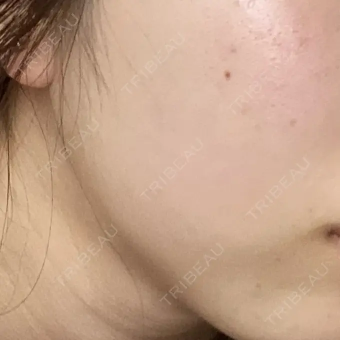 ボトックス（エラ・小顔） メディカルアルファクリニック BEFORE メイン用