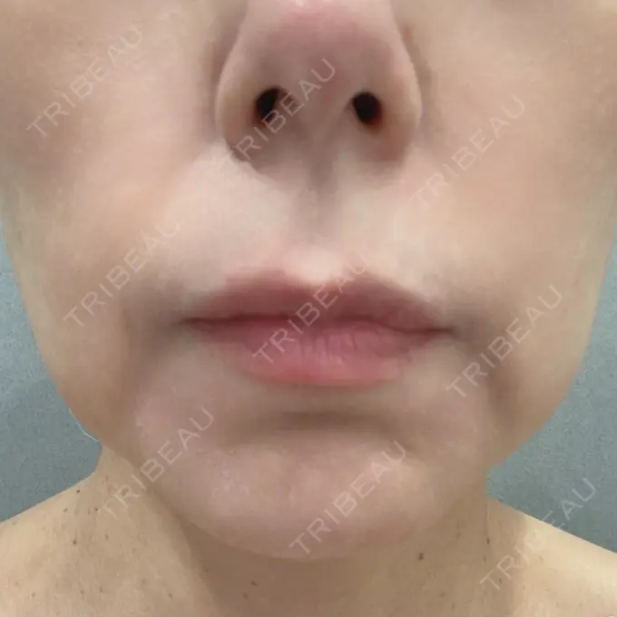 糸リフト / 肌ヒアルロン酸注入（たるみ・シワ改善） / 美容点滴・美容注射（疲労回復） アリエル美容クリニック 大宮院 BEFORE メイン用