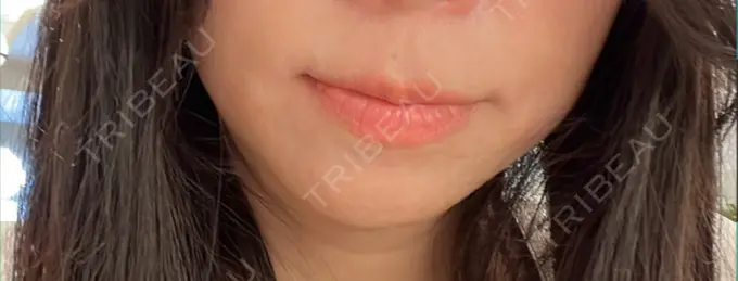 ボトックス（人中） しらゆりメディカルクリニック （旧しらゆりビューティークリニック） BEFORE メイン用