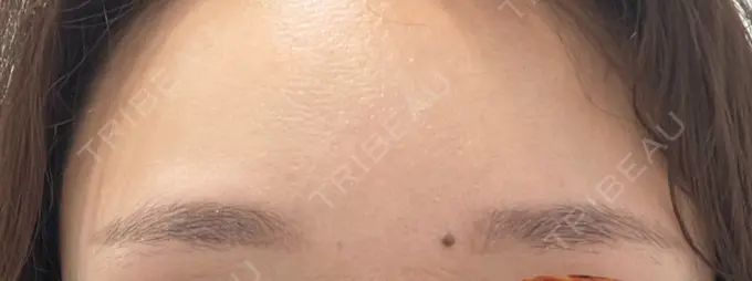 アートメイク（眉） 三鷹ヒロクリニック 北口院 （医療脱毛） BEFORE メイン用