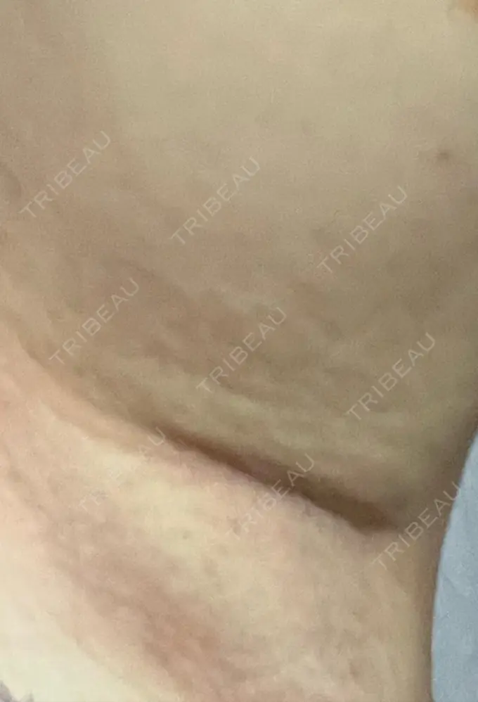 ワキ汗治療（レーザー） エースクリニック 名古屋院 BEFORE メイン用