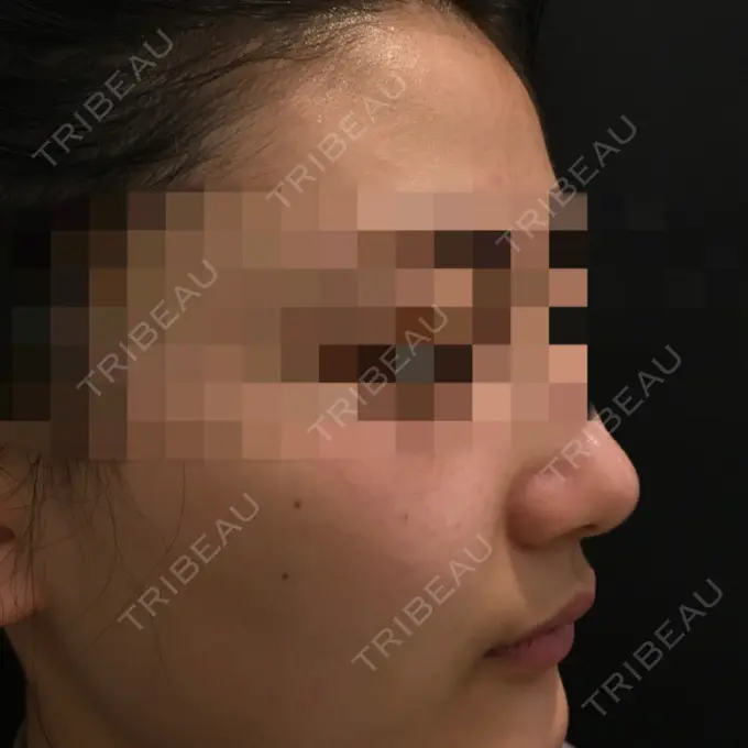 脂肪溶解注射（顔） 表参道ウィズ・クリニック BEFORE メイン用