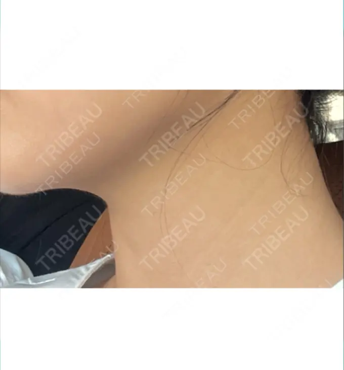 ハイフ（顔） HAAB BEAUTY CLINIC 横浜院 BEFORE メイン用