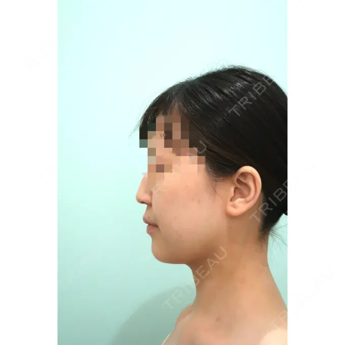 糸リフト / 脂肪吸引（顔） / ジョールファット除去 / ボトックス（エラ・小顔） WOM CLINIC GINZA （ワム クリニック ギンザ） BEFORE メイン用