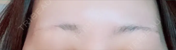 アートメイク（眉） 三鷹ヒロクリニック 北口院 （医療脱毛） BEFORE メイン用