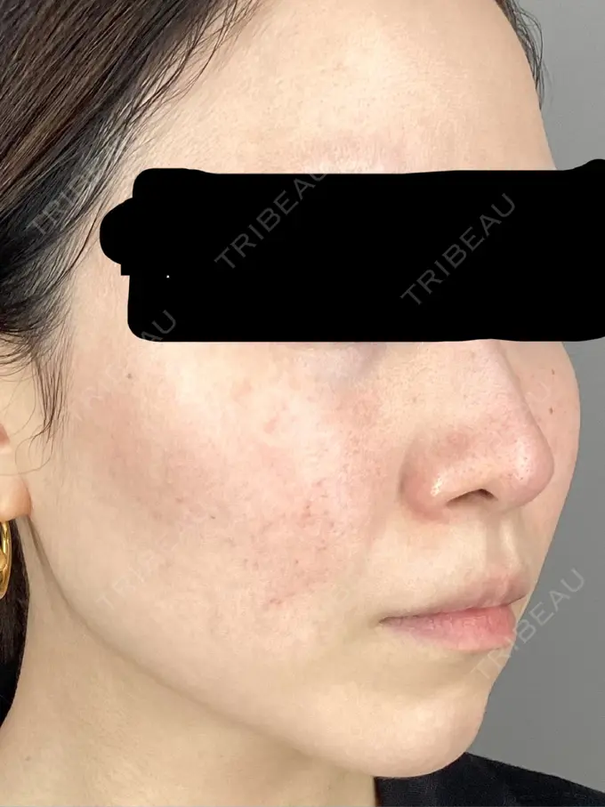 赤み除去レーザー 東京美容クリニック 表参道本院 BEFORE メイン用