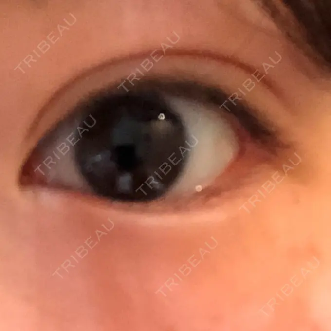 ヒアルロン酸注入（涙袋） フィラークリニック 新宿院 BEFORE メイン用