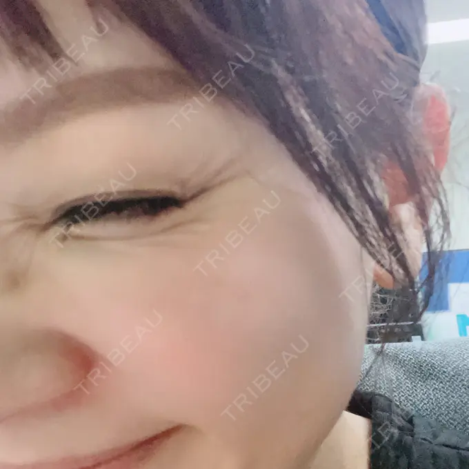 ボトックス（目尻） TCB東京中央美容外科 八王子院 BEFORE メイン用