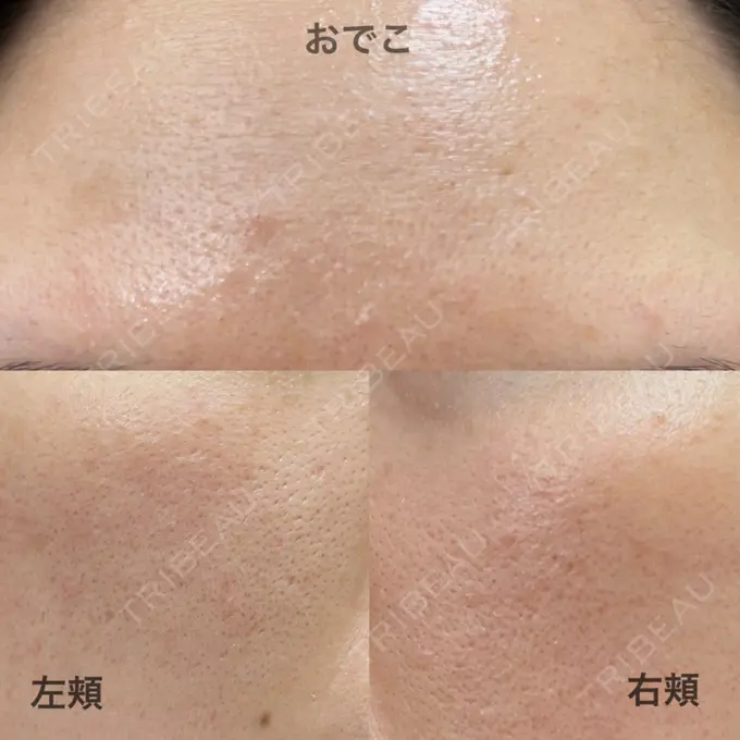 レーザーフェイシャル 石倉クリニック 水戸院 BEFORE メイン用