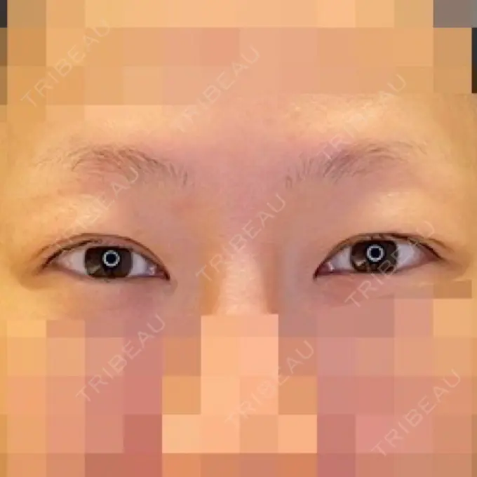 目尻切開 / タレ目形成・グラマラスライン（埋没） LOUIS CLINIC 二子玉川院【ルイクリニック】 BEFORE メイン用