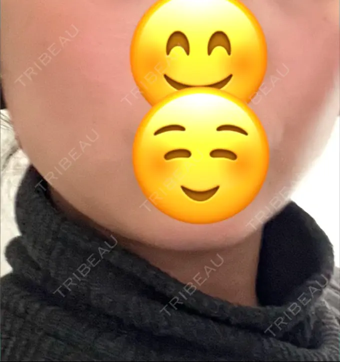 ボトックス（エラ・小顔） L‘amour clinic Tokyo【ラムールクリニック東京】 BEFORE メイン用