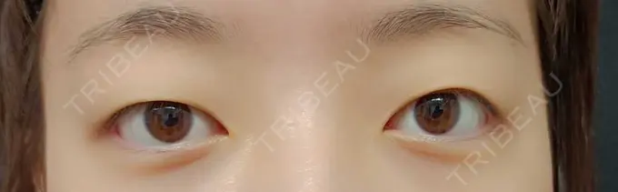 二重埋没 湘南美容クリニック 京都院 BEFORE メイン用