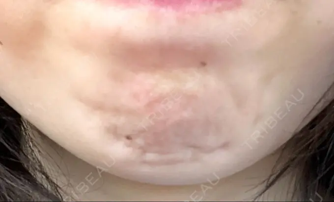 ボトックス（あご） フィラークリニック 町田院 BEFORE メイン用