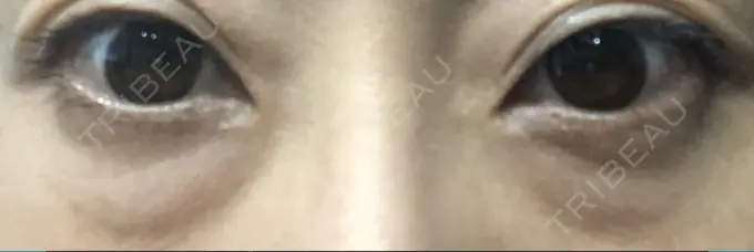 クマ治療 / 下まぶたたるみ取り / 脂肪注入（目の下） 湘南美容クリニック Regno 銀座院 BEFORE メイン用