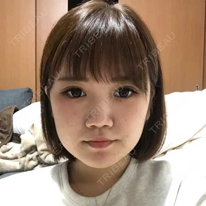 骨切り（あご） / 脂肪吸引（顔） 東京美容外科 赤坂院 BEFORE メイン用