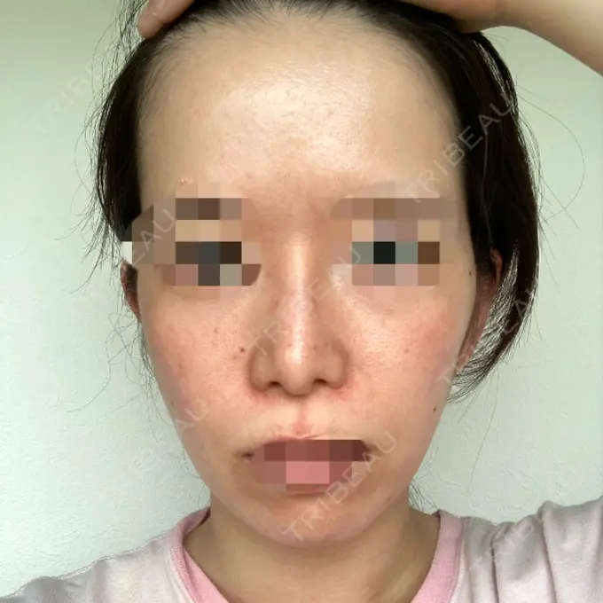 その他（肌） / イオン導入 / ルメッカ ルラ美容クリニック 横浜院 BEFORE メイン用