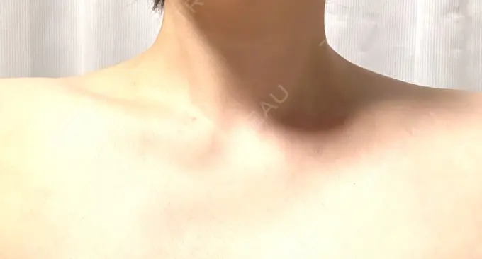 ボトックス（肩） 湘南美容クリニック 静岡院 BEFORE メイン用