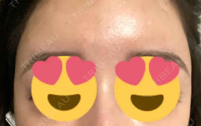 ボトックス（額） 東京美容医療クリニック 池袋院 BEFORE メイン用