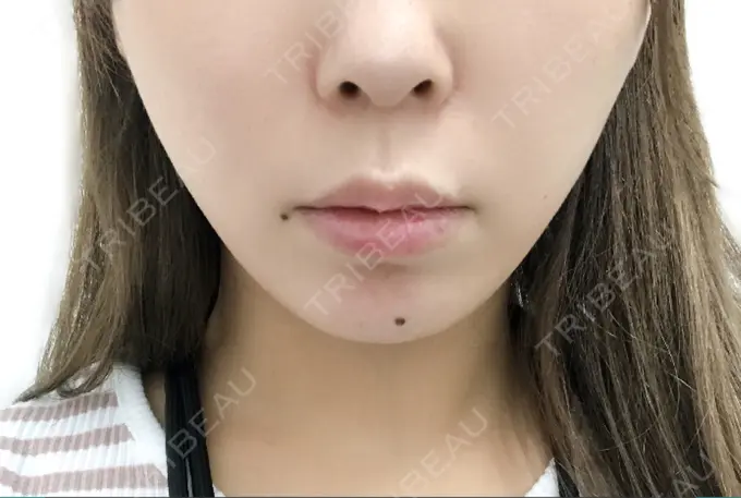 ボトックス（あご） / ヒアルロン酸注入（あご） / ボトックス（エラ・小顔） / ヒアルロン酸注入（唇） 川越TAクリニックアソシエ BEFORE メイン用